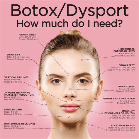 botox dysport map.